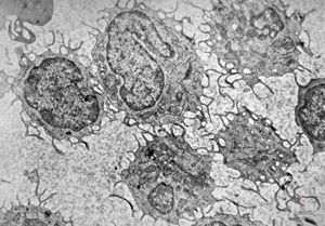 M,38y. | blood - hairy cell leukemia